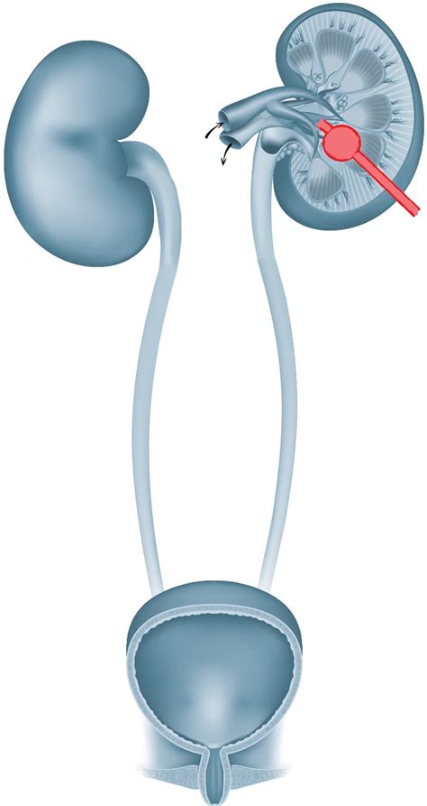 nierenkatheter|Perkutane Nephrostomie: Anlage einer Nierenfistel